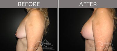 Breast Lift with Augmentation Before & After Gallery - Patient 132099630 - Image 3