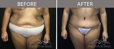 Abdominoplasty Before & After Gallery - Patient 90705092 - Image 1