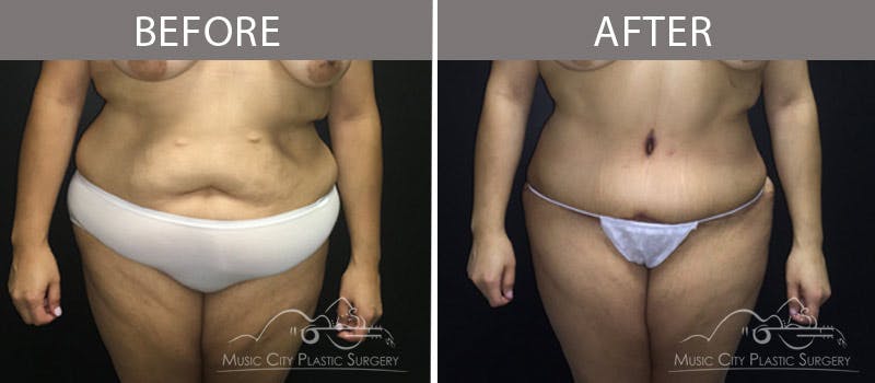Abdominoplasty Before & After Gallery - Patient 90705092 - Image 1
