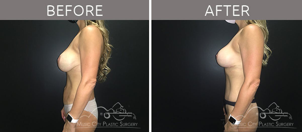 Mommy Makeover Before & After Gallery - Patient 90705108 - Image 3