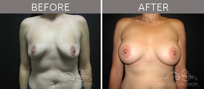 Breast Augmentation Before & After Gallery - Patient 90705087 - Image 3