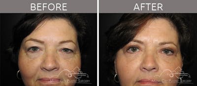 Blepharoplasty Before & After Gallery - Patient 90705110 - Image 1