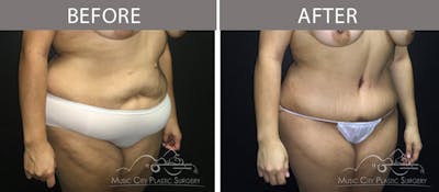 Abdominoplasty Before & After Gallery - Patient 90705092 - Image 2