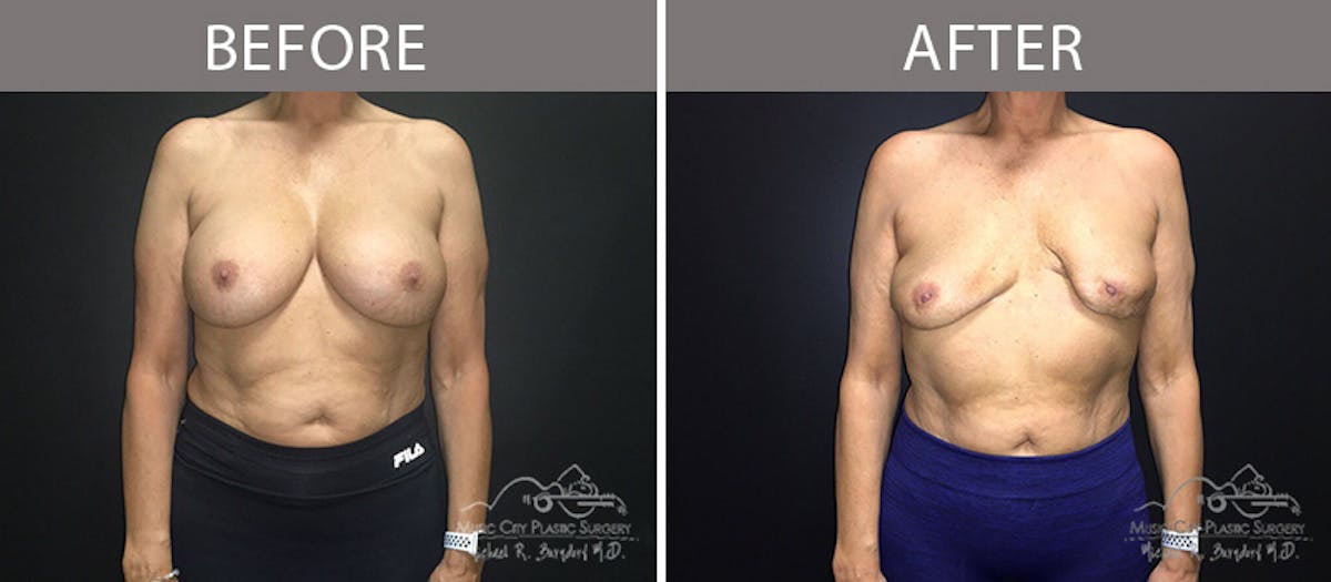 Capsulectomy Before & After Gallery - Patient 90705090 - Image 1