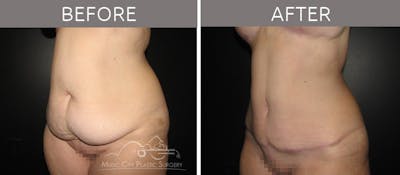 Breast Lift with Augmentation Before & After Gallery - Patient 132099630 - Image 3
