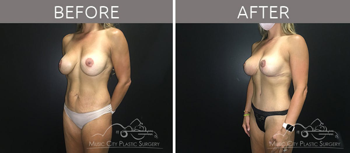 Breast Lift with Augmentation Before & After Gallery - Patient 132099743 - Image 2