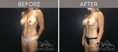 Mommy Makeover Before & After Gallery - Patient 90705108 - Image 2