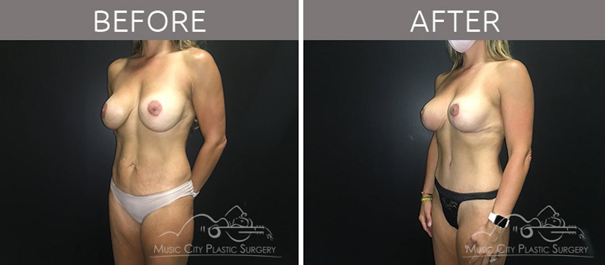 Mommy Makeover Before & After Gallery - Patient 90705108 - Image 2