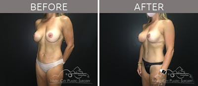 Breast Lift with Augmentation Before & After Gallery - Patient 132099743 - Image 2