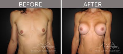 Breast Augmentation Before & After Gallery - Patient 90705101 - Image 1