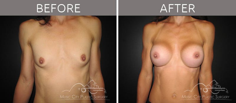 Breast Augmentation Before & After Gallery - Patient 90705101 - Image 1