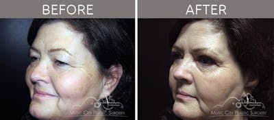 Blepharoplasty Before & After Gallery - Patient 90705110 - Image 2