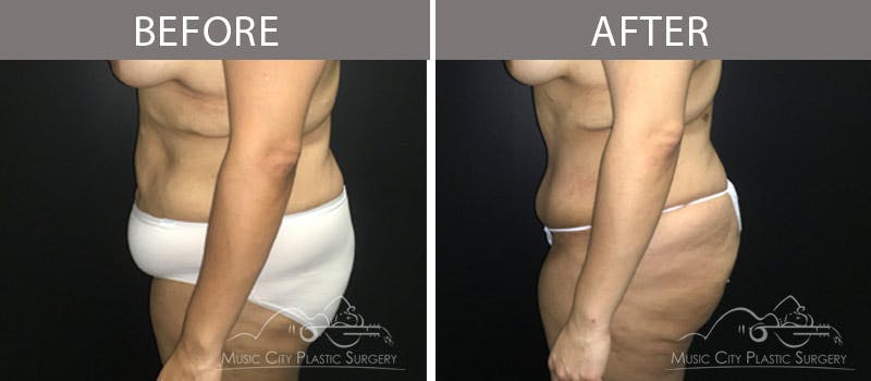 Abdominoplasty Before & After Gallery - Patient 90705092 - Image 3