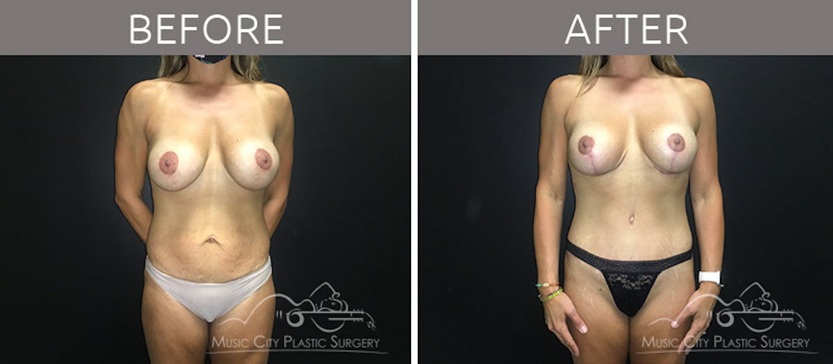 Breast Lift with Augmentation Before & After Gallery - Patient 132099743 - Image 1