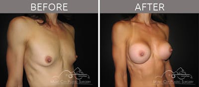 Breast Augmentation Before & After Gallery - Patient 90705101 - Image 2