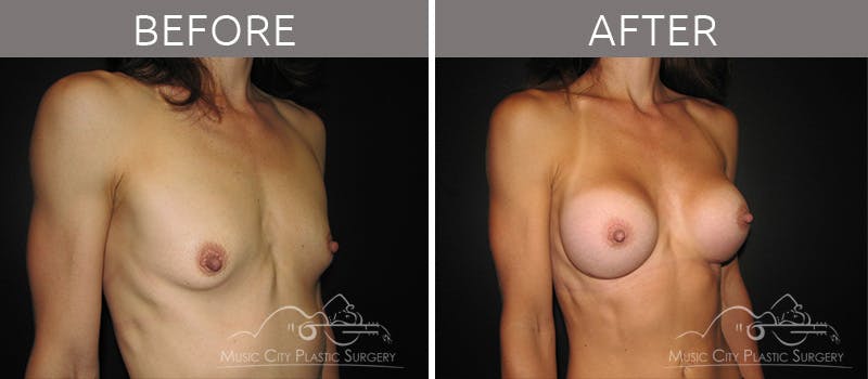 Breast Augmentation Before & After Gallery - Patient 90705101 - Image 2