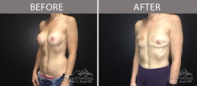 Capsulectomy Before & After Gallery - Patient 90705109 - Image 2