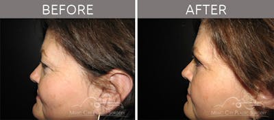 Blepharoplasty Before & After Gallery - Patient 90705110 - Image 3