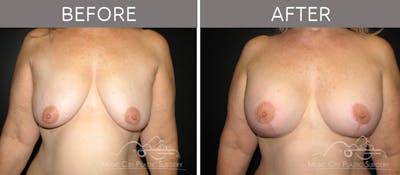 Breast Lift with Augmentation Before & After Gallery - Patient 132099630 - Image 1