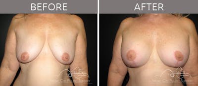 Breast Lift with Augmentation Before & After Gallery - Patient 132099630 - Image 1