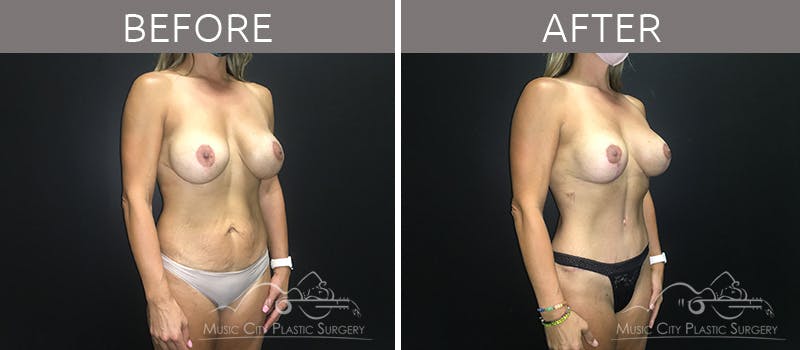 Breast Lift with Augmentation Before & After Gallery - Patient 132099743 - Image 4