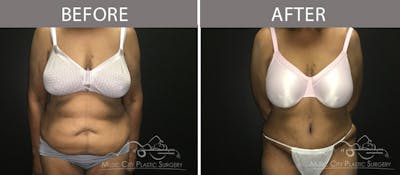 Abdominoplasty Before & After Gallery - Patient 90705111 - Image 1