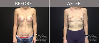 Capsulectomy Before & After Gallery - Patient 90705109 - Image 1