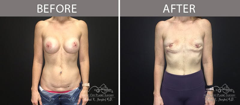 Capsulectomy Before & After Gallery - Patient 90705109 - Image 2