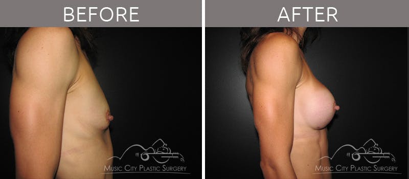 Breast Augmentation Before & After Gallery - Patient 90705101 - Image 3