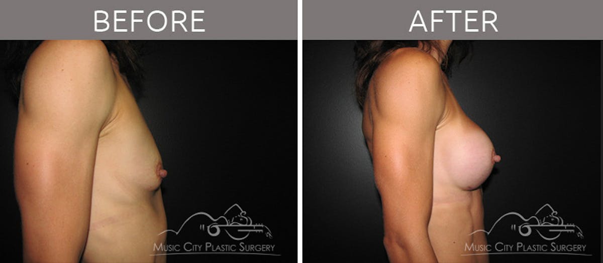 Breast Augmentation Before & After Gallery - Patient 90705101 - Image 3