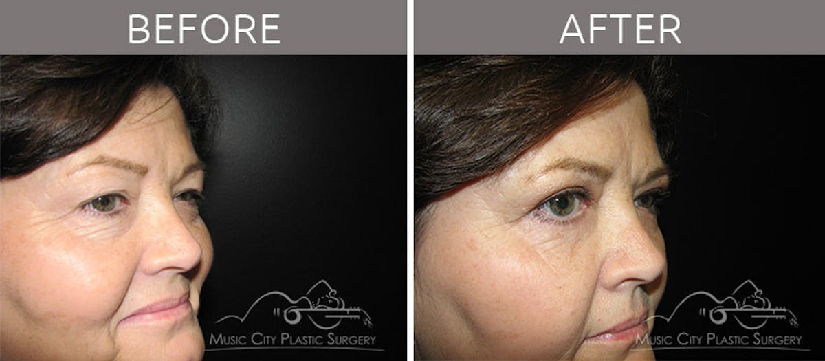 Blepharoplasty Before & After Gallery - Patient 90705110 - Image 4