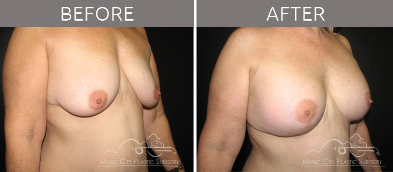 Breast Lift with Augmentation Before & After Gallery - Patient 132099630 - Image 6