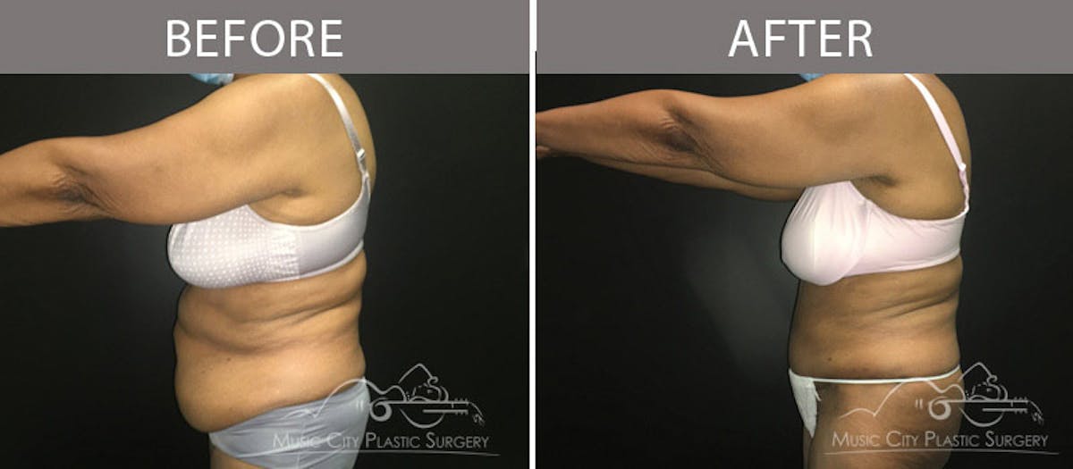 Abdominoplasty Before & After Gallery - Patient 90705111 - Image 3