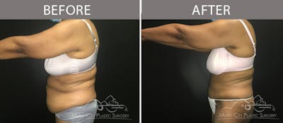 Abdominoplasty Before & After Gallery - Patient 90705111 - Image 3