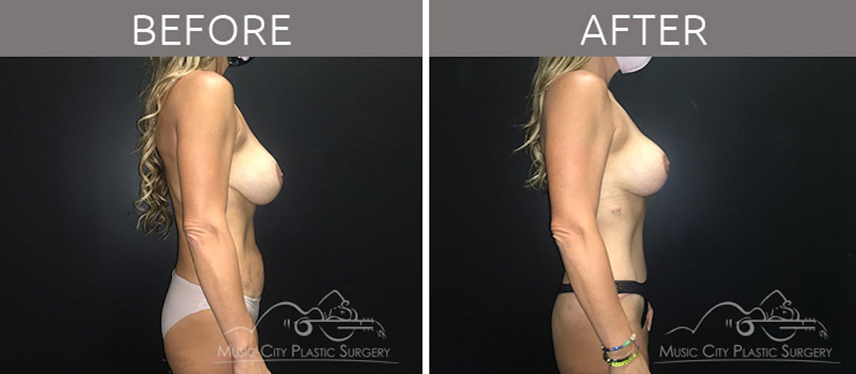 Mommy Makeover Before & After Gallery - Patient 90705108 - Image 5