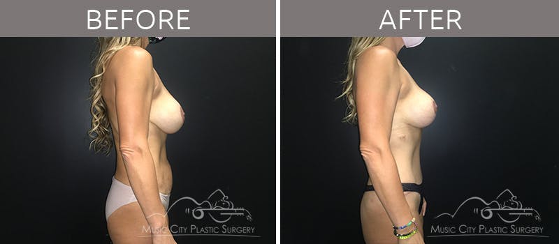 Breast Lift with Augmentation Before & After Gallery - Patient 132099743 - Image 5