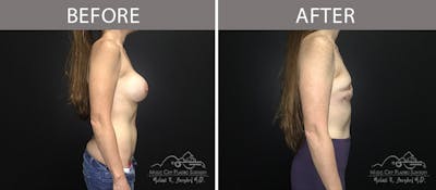 Capsulectomy Before & After Gallery - Patient 90705109 - Image 3