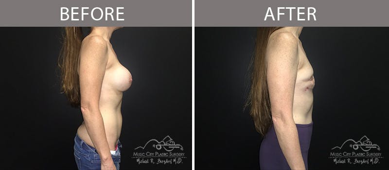 Capsulectomy Before & After Gallery - Patient 90705109 - Image 3