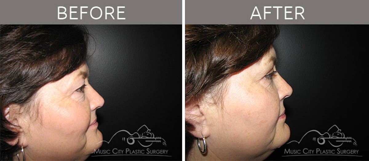 Blepharoplasty Before & After Gallery - Patient 90705110 - Image 5
