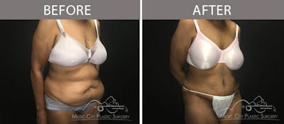 Abdominoplasty Before & After Gallery - Patient 90705111 - Image 2