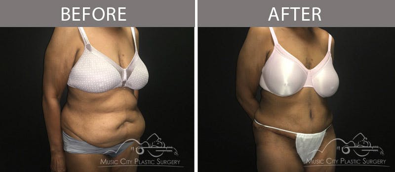 Abdominoplasty Before & After Gallery - Patient 90705111 - Image 3