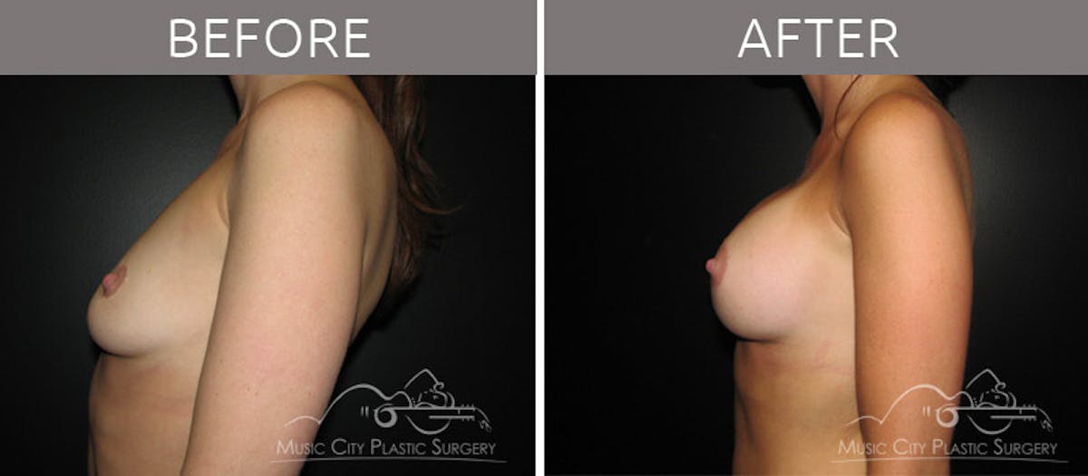 Breast Augmentation Before & After Gallery - Patient 90705116 - Image 3