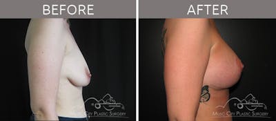 Breast Lift with Augmentation Before & After Gallery - Patient 132099629 - Image 3