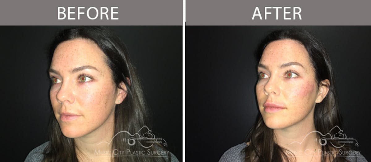 Dermal Fillers Before & After Gallery - Patient 90705112 - Image 1