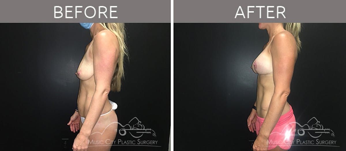 Mommy Makeover Before & After Gallery - Patient 90705129 - Image 3
