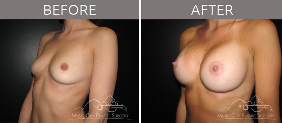 Breast Augmentation Before & After Gallery - Patient 90705116 - Image 2