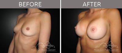 Breast Augmentation Before & After Gallery - Patient 90705116 - Image 2
