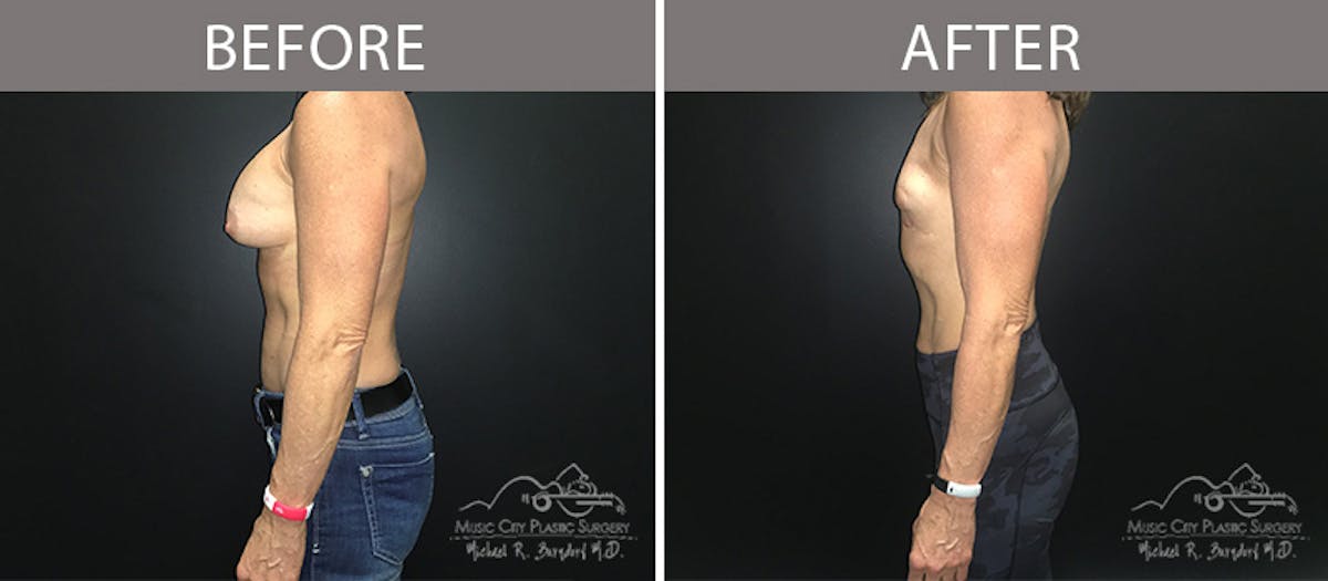 Capsulectomy Before & After Gallery - Patient 90705130 - Image 3