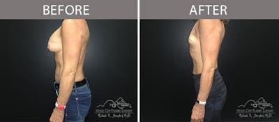 Capsulectomy Before & After Gallery - Patient 90705130 - Image 3