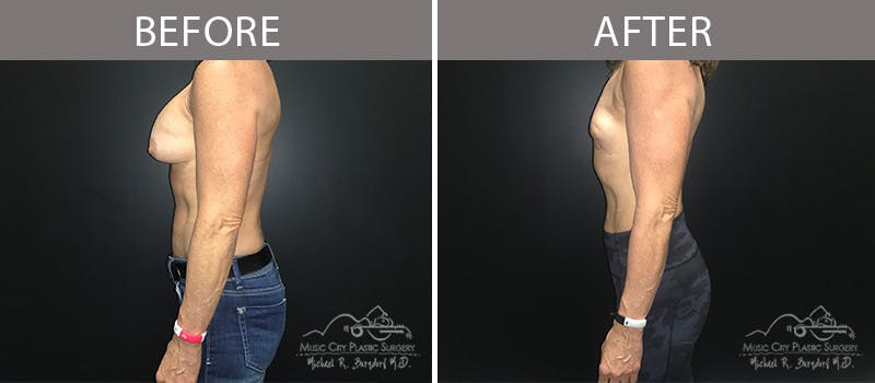 Capsulectomy Before & After Gallery - Patient 90705130 - Image 1
